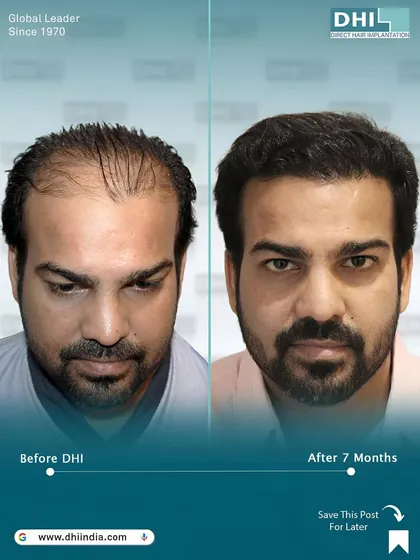 A truly life-changing transformation after 7 months. This before and after showcases the power of the DHI technique to completely restore a hairline, providing full coverage and natural density that looks and feels real.
