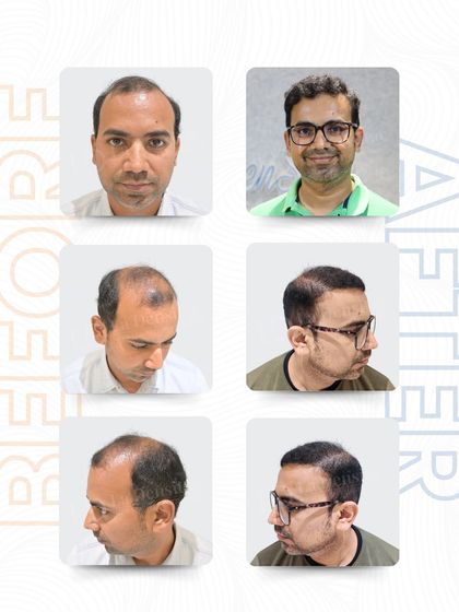 Hrishikesh Kshirsagar struggled with a thinning hairline that affected his confidence. With 4,148 grafts using the RT-FUE technique, I rebuilt his hairline to look completely natural, and today he carries himself with the confidence he thought he had lost.