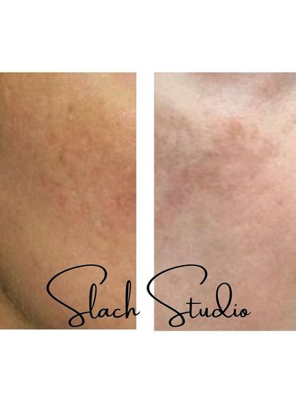 This image focuses on the improvement of skin texture, showing how the treatment can reduce the appearance of pores and rough patches.