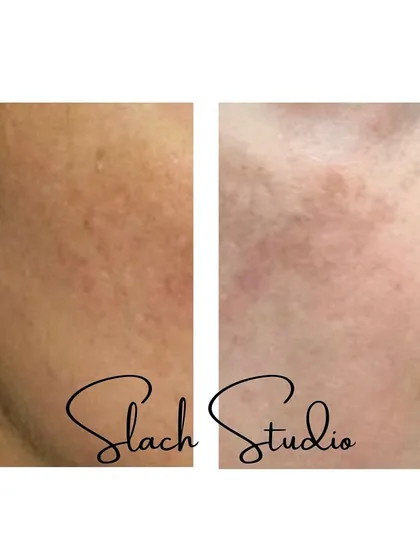 This image focuses on the improvement of skin texture, showing how the treatment can reduce the appearance of pores and rough patches.