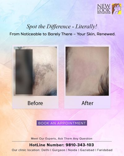 Tattoo Removal