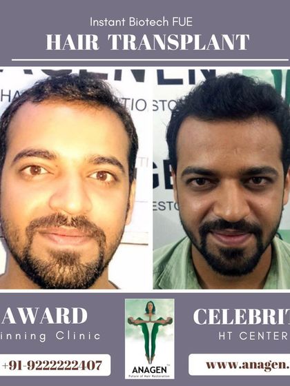 Another excellent result from our award winning clinic. The patient's transformation is clear, with a much fuller and healthier looking head of hair.