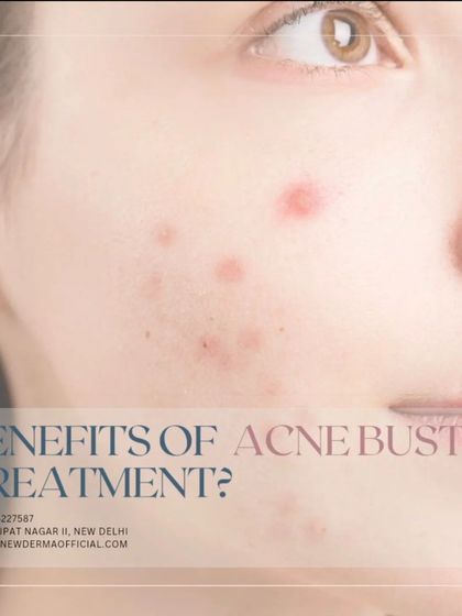 A close-up visual highlighting the benefits of our acne buster treatment. It is designed to target active acne and prevent future breakouts, leading to clearer and healthier skin.