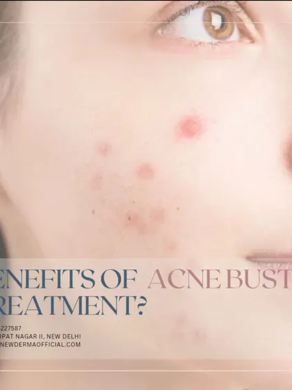 The Acne Buster medi-facial is designed to provide relief from damage caused by free radicals and deeply hydrate the skin, helping to clear acne and prevent future breakouts.