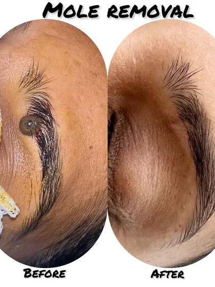 This image demonstrates a precise mole removal from a delicate area on the eyebrow. We perform this simple, scarless procedure to safely remove unwanted growths, ensuring a clean and aesthetically pleasing result with minimal downtime.
