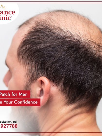This side view shows typical male pattern baldness. My hair patch service is designed to cover this area perfectly and revive your confidence with a natural look.