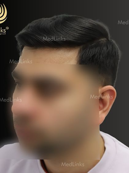 The final result from the side, showing a restored and natural hairline.