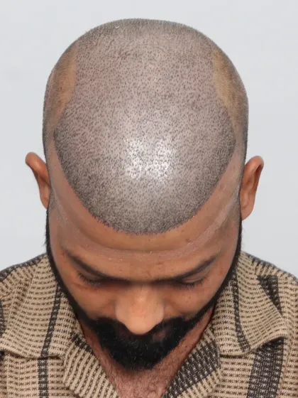 This 13-month result for a Grade 6 baldness case shows what's possible with 6300 grafts. We restored his hair, style, and youthful appearance.