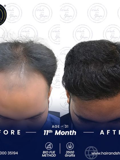 This top-down view at 11 months shows how the BIO FUE technique provided excellent density and coverage for a complete transformation.