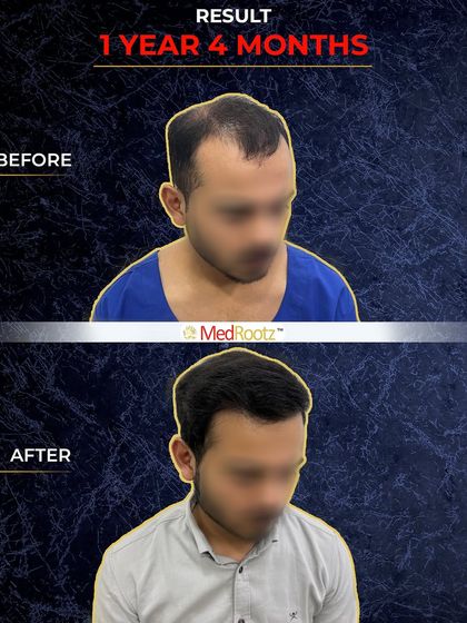 This image shows Naseem's final result, 1 year and 4 months after his procedure. The hair has fully matured, resulting in a thick, healthy appearance that looks completely natural.
