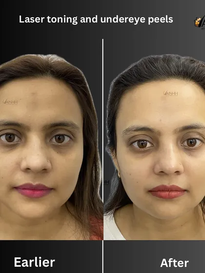 This patient's transformation was achieved over three months with a combination of laser toning for overall facial pigmentation and targeted under-eye peels to address dark circles, resulting in a brighter and more refreshed appearance.