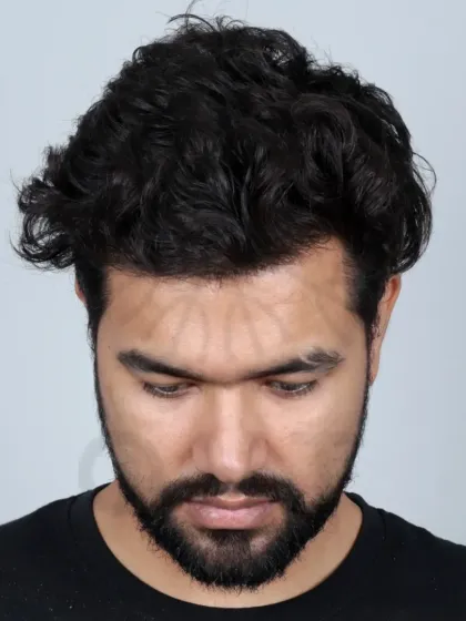 A 10-month natural transformation for a Grade 3 baldness case using 3700 grafts. We recreated the hairline, temples, and frontal zone.