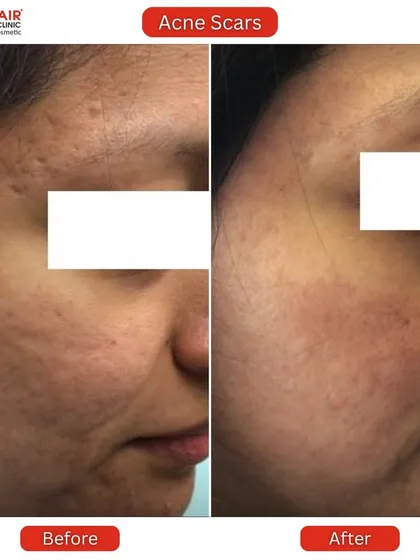 This is the kind of transformation that inspires us every day. This client came to us with deep, textured acne scars and uneven skin tone. Through a personalized treatment plan, we were able to significantly smooth the skin's surface, reduce the depth of the scars, and restore a healthier, more even complexion.