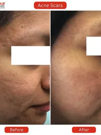 Skin Resurfacing & Scar Treatment