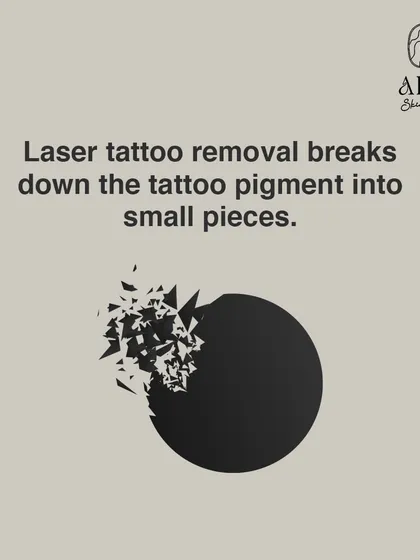 The core principle of laser tattoo removal is breaking down large pigment particles into smaller pieces that the body can eliminate naturally.