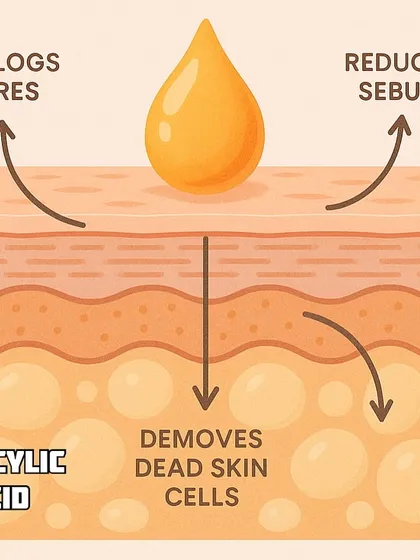 This diagram shows exactly how Salicylic Acid, a key ingredient for acne-prone skin, works. It penetrates into the pores to remove dead skin cells, unclog pores, and reduce sebum, making it a hero ingredient in many of my personalized plans.