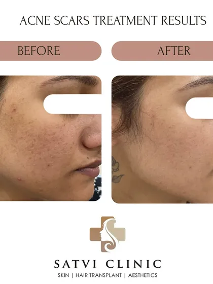 Another example of successful acne scar revision. This patient's results show a visible improvement in rolling scars and post-acne pigmentation. Each treatment plan is customized, and can include procedures like MNRF, chemical peels, or subcision depending on the scar type.