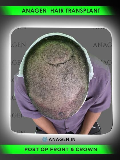 A top down view of the post operative result, showing both the frontal and crown areas. The even distribution of grafts ensures uniform density and coverage across the entire transplant zone.