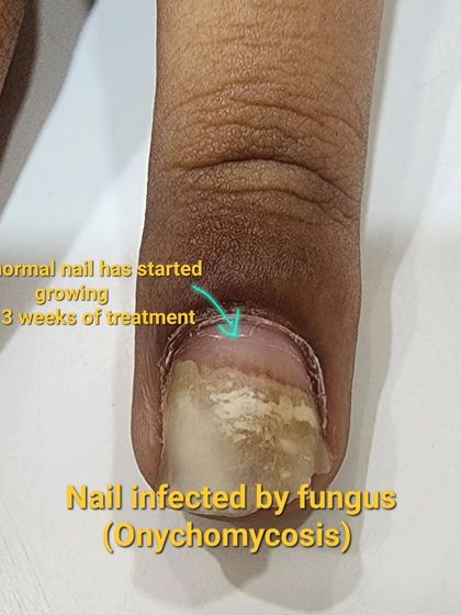 This close-up shows a fungal nail infection (Onychomycosis) with new, healthy nail growth visible after only three weeks of treatment. It highlights the importance of getting a proper diagnosis and starting a treatment plan early for the best results.