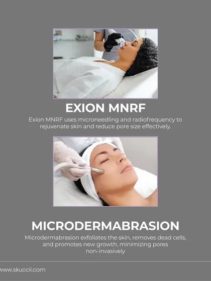For clients concerned with pore size, we offer multiple effective solutions. Exion MNRF uses microneedling and radiofrequency to rejuvenate skin and reduce pore size, while Microdermabrasion exfoliates dead cells to promote new growth and minimize pores non-invasively.