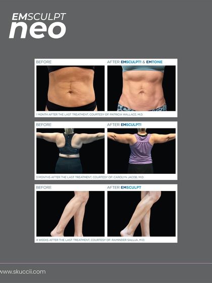 These before and after photos display the results of Emsculpt Neo on various body parts, including the abdomen, arms, and legs. They showcase the treatment's versatility in toning muscle and reducing fat across different areas for a complete body transformation.