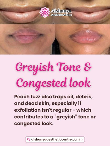 Peach fuzz can trap oil and debris, leading to a congested or grayish look. This before-and-after of the lip area shows how removing it can instantly brighten the skin.