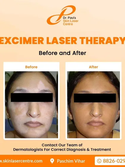This patient saw a significant restoration of skin color on her face after undergoing Excimer laser therapy. This treatment is highly effective for targeting specific, stubborn patches of vitiligo by using a focused beam of light to stimulate repigmentation.