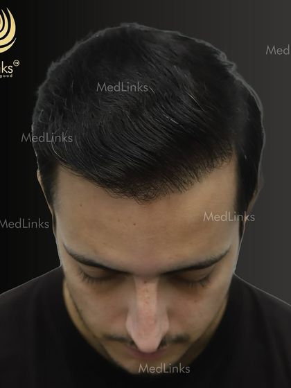 The top-down view after the transplant, showcasing the full coverage achieved.