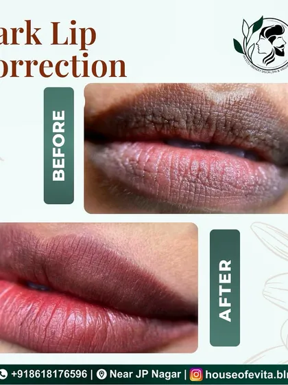 This is a life-changing Dark Lip Correction. I carefully neutralized the cool, dark tones to reveal a brighter, more even, and naturally rosy color. This semi-permanent treatment eliminates the need for constant lipstick application.