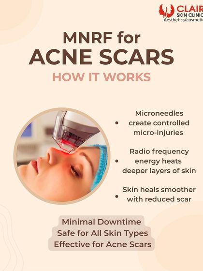This graphic explains how MNRF for acne scars works. Microneedles create controlled micro-injuries while radiofrequency energy heats deeper skin layers, causing the skin to heal smoother with reduced scarring.