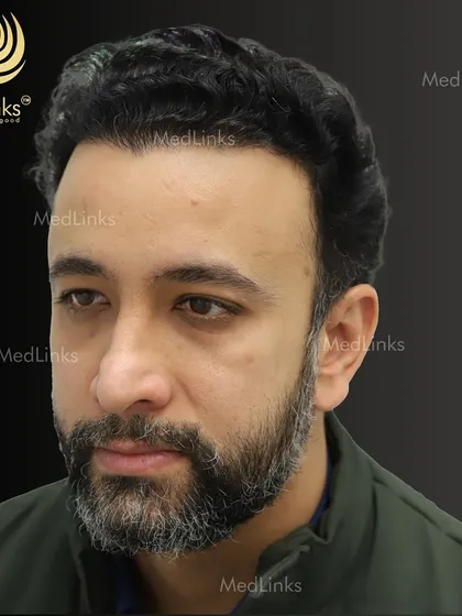 The final result from the side, showing a strong and natural hairline.