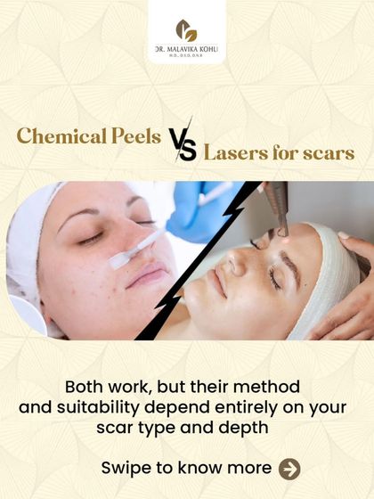 When treating scars, it is essential to differentiate between surface-level and structural issues. Chemical peels primarily address superficial texture and pigmentation, while fractional lasers target deeper dermal layers to remodel collagen. The choice of modality depends entirely on the scar type and depth.