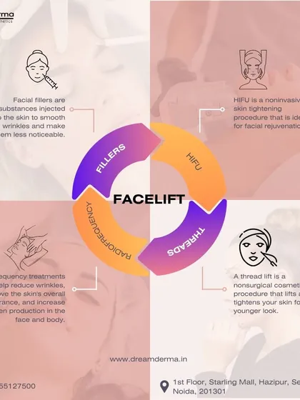 This diagram illustrates the four pillars of my non-surgical facelift approach: Fillers for volume, HIFU for deep lifting, Threads for contouring, and Radiofrequency for tightening.
