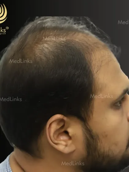 A side profile before the procedure, highlighting the receding hairline and thinning on top. Our goal is to create a result that looks natural from every angle.