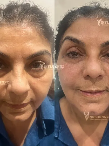 A full-face rejuvenation using dermal fillers can create a remarkable yet natural transformation. By strategically restoring volume to areas like the cheeks and under-eyes, we can lift the entire face, reduce shadows, and bring back a refreshed, youthful appearance.