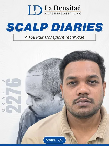 Look closely at Gautham Kumar's transformation. With 2,276 grafts using my advanced RT-FUE technique, I crafted a dense, natural hairline designed just for him. This is what precision-driven results look like.