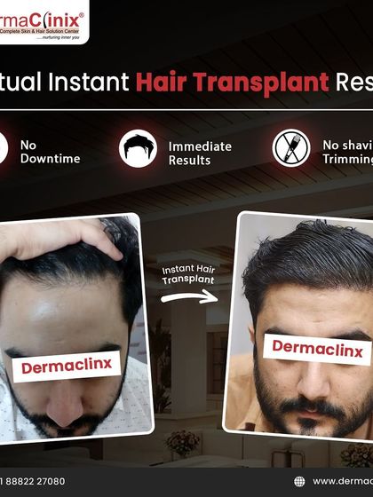 This image highlights the benefits of our Instant Hair Transplant using the Long Hair FUE method. It offers no downtime, no shaving, and immediate results, allowing you to enjoy a festive season with renewed confidence.