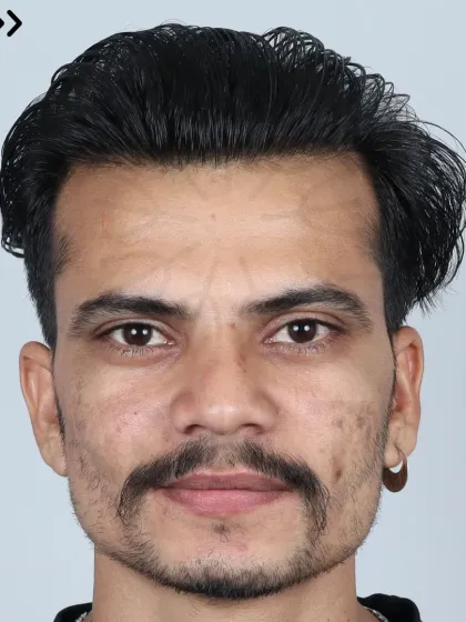 This 33-month result for a Grade 6 patient shows the long-lasting and natural outcome of his 4700-graft procedure.