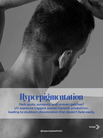 Sun damage often leads to hyperpigmentation. UV exposure triggers excess melanin production, resulting in dark spots and uneven patches that are stubborn to treat.