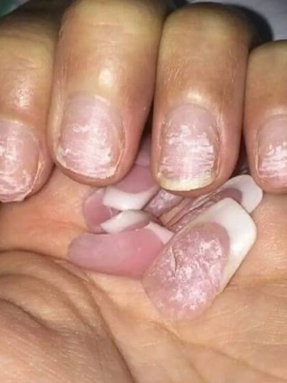 This image shows the damage that can happen when you peel or rip off your nail extensions. I teach my students the importance of educating clients on safe removal to protect their natural nail health.
