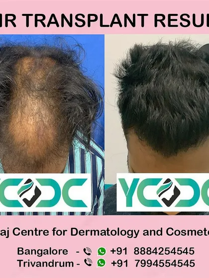 This top-down view shows the impressive coverage achieved for a patient with advanced thinning on the crown and mid-scalp.