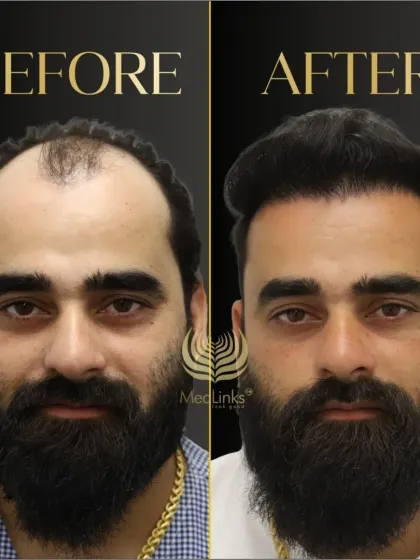 A great example of a full hair restoration. The patient's before and after photos show a complete transformation, restoring both his hair and his confidence.