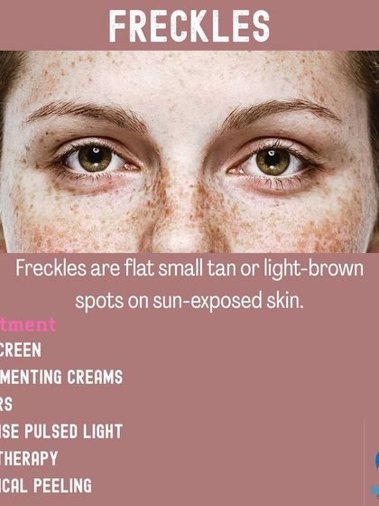 This graphic provides information on freckles, which are small tan spots on sun exposed skin. I offer various treatments, including lasers and chemical peels, to effectively reduce their appearance.