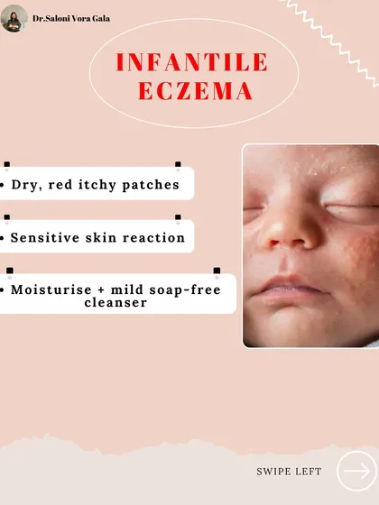 Infantile Eczema shows up as dry, red, itchy patches due to a sensitive skin reaction. Management involves using a mild, soap-free cleanser and moisturizing the skin regularly.