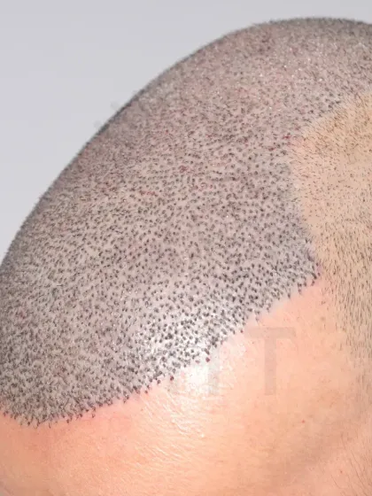 A close-up of graft placement for a Norwood Grade 6 case. 6000 grafts were implanted in a single session for full coverage.