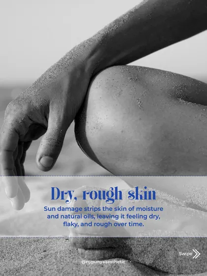 If your skin feels persistently dry and rough, sun damage could be the culprit. It strips the skin of its natural moisture and oils over time, leaving it flaky and dehydrated.