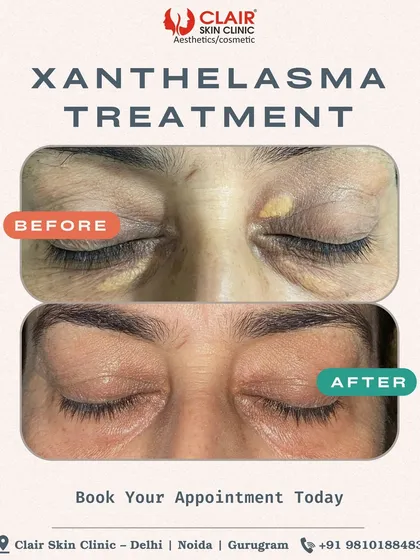 This transformation shows the successful treatment of Xanthelasma, the yellowish deposits around the eyes. Our non-surgical method completely clears these deposits, restoring a smooth and even appearance to the delicate eye area.