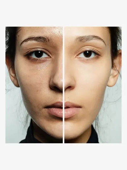 The goal of our anti-acne range is to take your skin from a state of inflammation and scarring to a calm, clear, and healthy complexion. Consistency is key to seeing these before and after results.