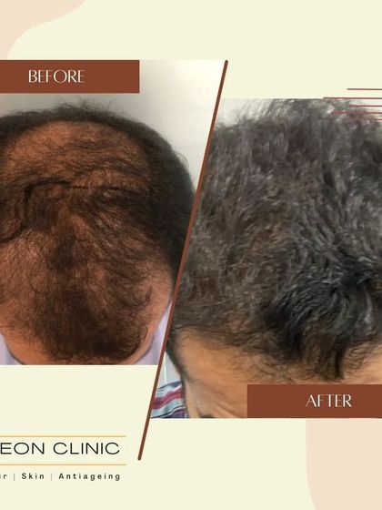 Addressing significant hair loss across the scalp, this before-and-after demonstrates a life-changing restoration of hair and confidence.