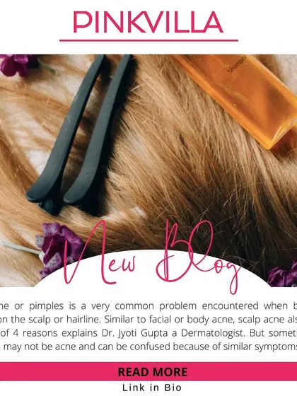 In this article, I discuss the causes of scalp acne, which can range from clogged pores to bacterial growth. Understanding the root cause is essential for finding the right treatment and preventing future breakouts.